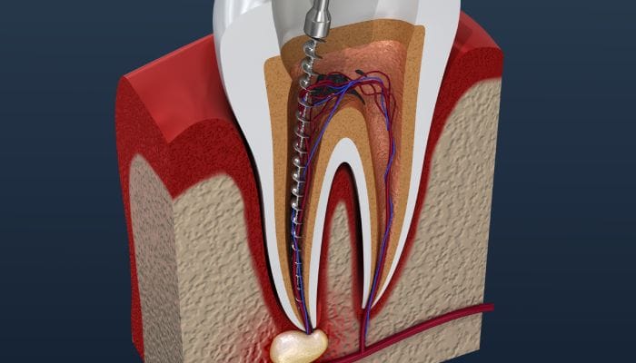 A representation of the root canal process, wherein a drill enters the roots of a tooth to remove the decay deep within.